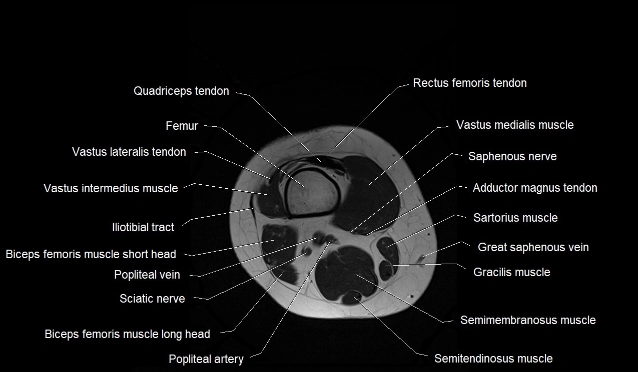 MRI thigh cross sectional anatomy image 49.webp